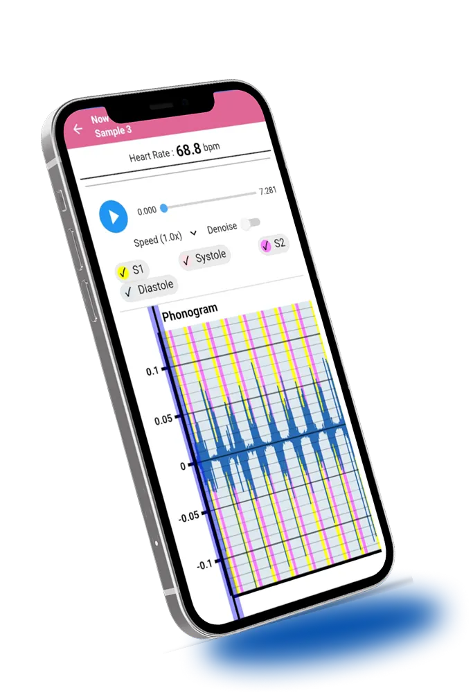 Digital electronic stethoscope with smartphone digital display showing real-time heart and lung sound visualization